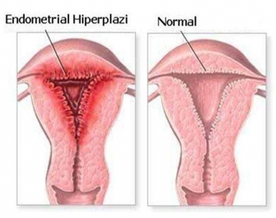 Endometrial Hiperplazi nedir